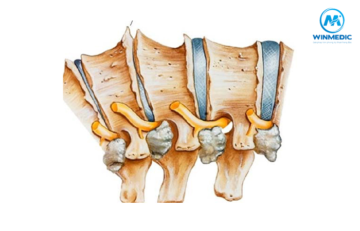 Những phương pháp điều trị gai cột sống thắt lưng hiệu quả 2 gai cot song that lung benh ly thuong gap