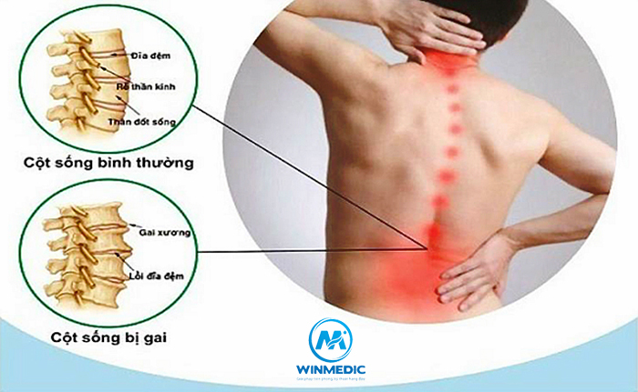 Những phương pháp điều trị gai cột sống thắt lưng hiệu quả 1 phuong phap dieu tri gai cot song that lung 1