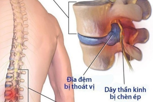 nguyen nhan khien ban dau lung lan xuong mong va chan 2 nguyen nhan khien ban dau lung lan xuong mong va chan 2