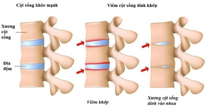 nguyen nhan khien ban dau lung lan xuong mong va chan 7 nguyen nhan khien ban dau lung lan xuong mong va chan 7