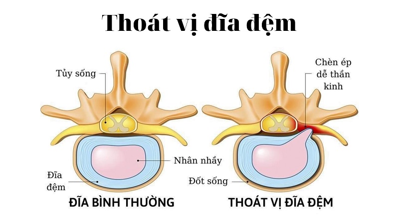 phuong phap dieu tri thoat vi dia dem khong phau thuat 1 phuong phap dieu tri thoat vi dia dem khong phau thuat 1